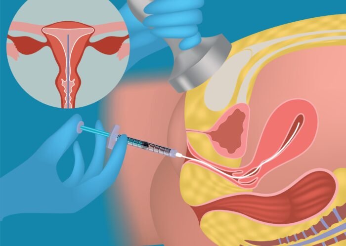 The embryo transfer procedure, under ultrasound control, involves placing the embryo into the woman's uterus using a thin and flexible catheter at the most optimal location in the uterus.